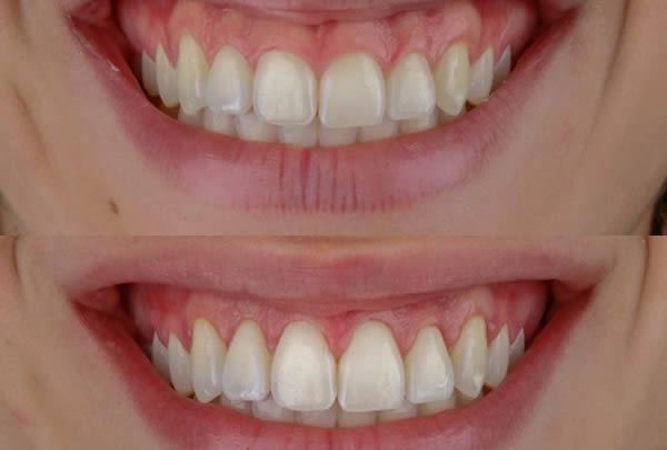 Gengivoplastia